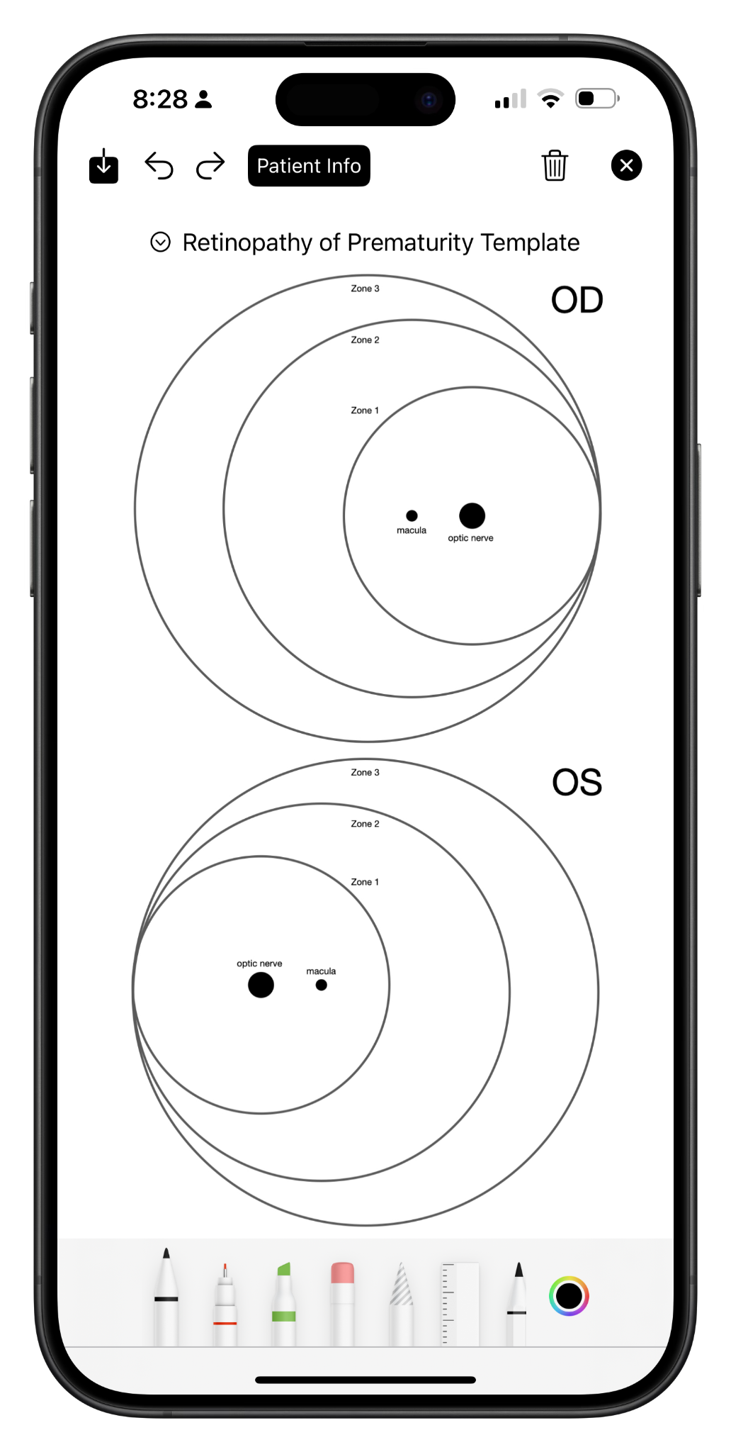 Retinopathy of Prematurity Drawing